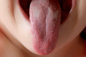 Skarlagensfeber smitter mellem personer