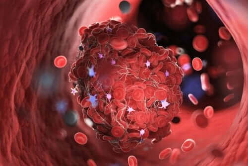 Illustration af flebitis