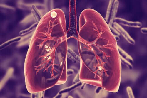 Hvad er lungetuberkulose og dets symptomer?