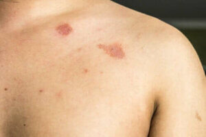 Beskrivelse og karaktertræk for Pityriasis Versicolor