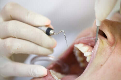 Paradentose: En problematisk sygdom i tandkød