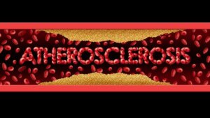 Åreforkalkning: Symptomer og behandling