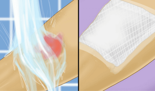 Behandling af forbrændinger på børn