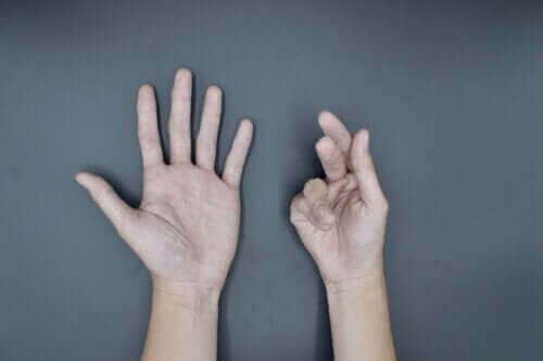 Årsager til Dupuytrens kontraktur og dens behandlinger