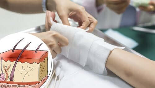 Læge behandler forbrænding på hånd