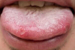Oral candidose: Naturlige behandlingsmidler