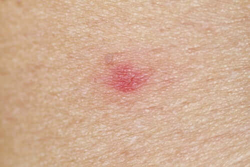 Rød plet på hud