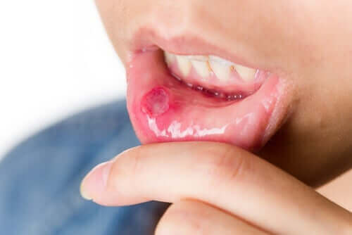 Person med sår i munden