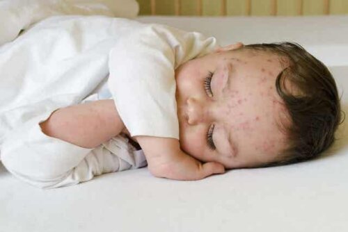 Baby med udslæt i ansigtet