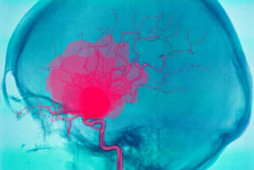 Hvad er en hjerneblødning, og hvorfor opstår det?