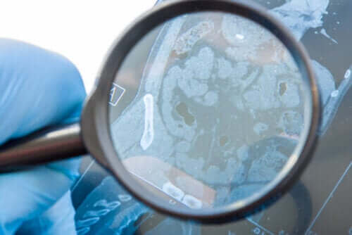 Hvad er en gastrointestinal fistel, og hvad forårsager den?