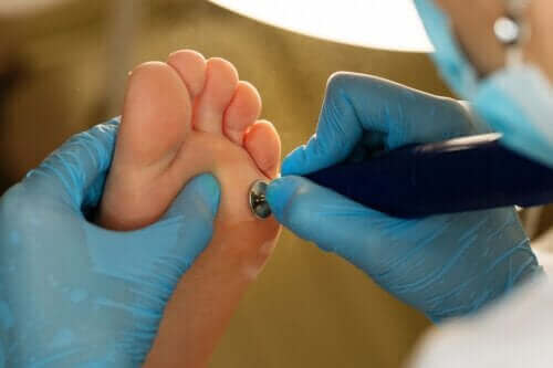 Lægelig behandling af ligtorne på hænder og fødder