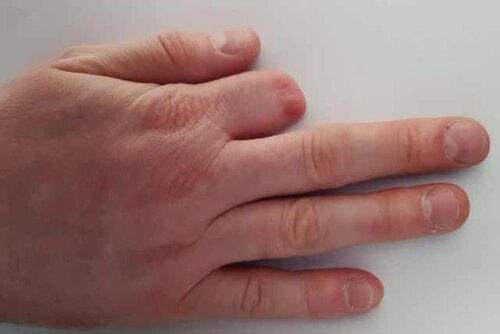 Amputeret finger