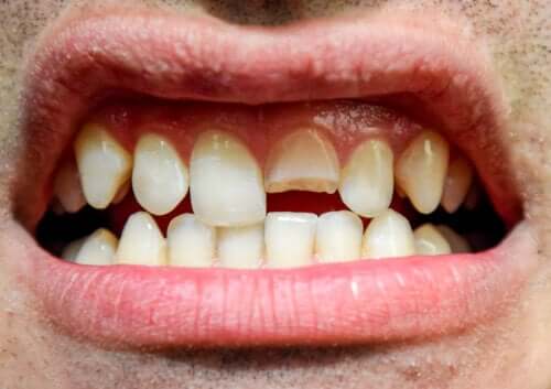 Tandskader: Hvad er det, og hvilke typer findes der?