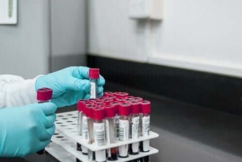 Rapid plasma reagin-test til diagnosticering af syfilis