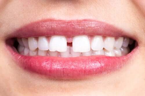 Karakteristika og årsager til mellemrum mellem tænderne