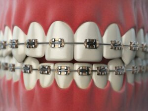 8 plejetips til mennesker med ortodonti