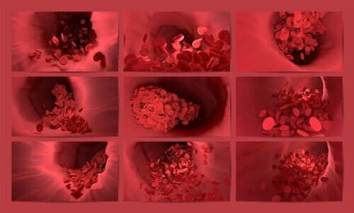 Fibrinolyse forhindrer dannelse af trombose