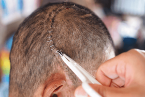 Hvad er en kraniotomi, og hvornår er det nødvendigt?