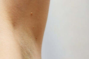 De mest almindelige behandlinger af hudgevækster under armene