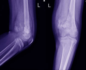Karakteristika for osteosarkom hos børn