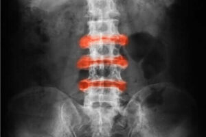 Verdensdag for ankyloserende spondylitis