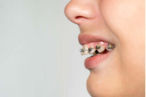 Hvad er et overbid, og hvordan kan du behandle det?