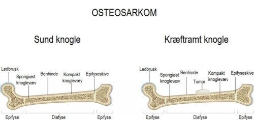 Illustration af osetosarkom hos børn