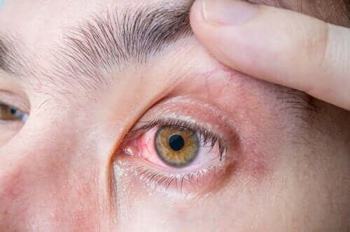 Melanom i øjet: Symptomer og årsager