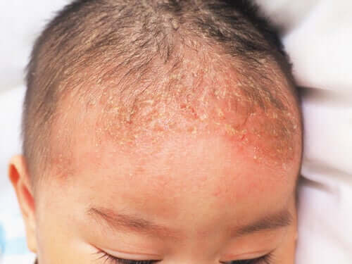 Hvad er seboroisk dermatitis hos spædbørn?
