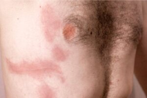 Trykket ribben: Årsager, symptomer og pleje