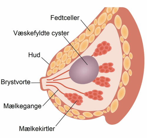 Illustration af cyster i brysterne