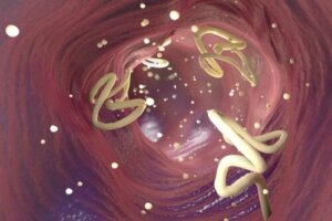 Du kan eliminere tarmparasitter med hvidløg og græskarkerner