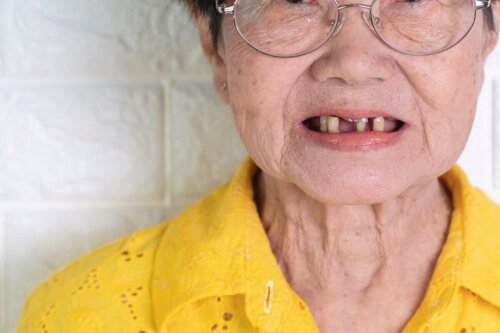Kvinde mangler tænder som eksempel på forholdet mellem demens og tandsundhed
