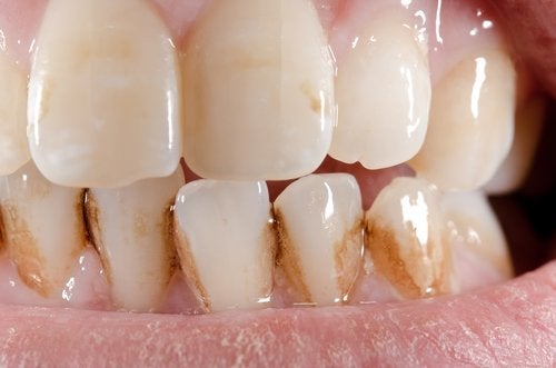 Sådan kan du fjerne tandsten naturligt fra dine tænder