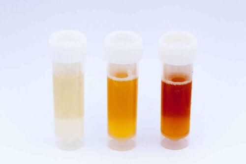 7 typer urin, der kan sige noget vigtigt om dit helbred