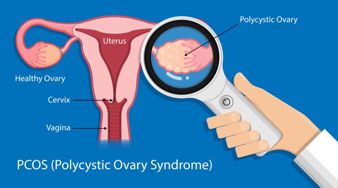Naturlig behandling af polycystisk ovariesyndrom