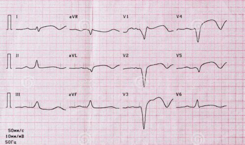 Elektrokardiogram
