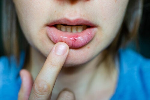 Hjemmemidler mod sår i munden