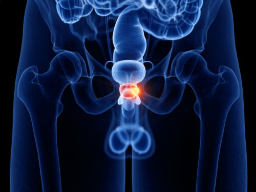 Illustration af prostatitis