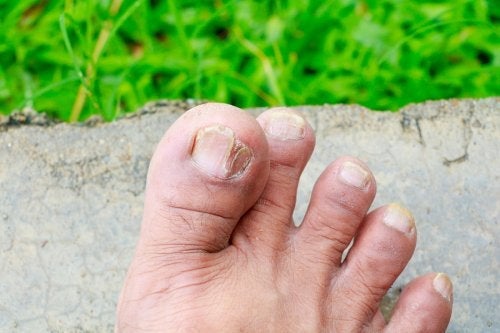 5 typer af hudsvamp og hvordan man identificerer dem