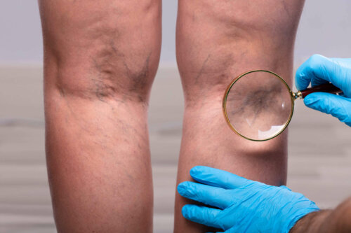 Åreknuder fører til smerter bag knæet