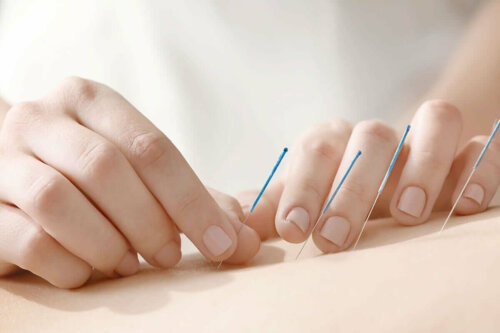 Akupunktur som en del af integrativ medicin