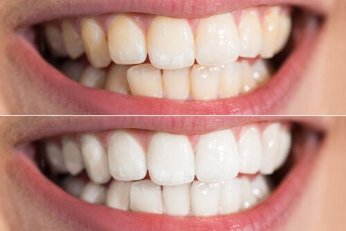 Er det sikkert at blege tænderne derhjemme? Mulige risici og anbefalinger