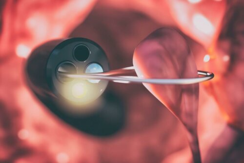 Illustration af rekto-sigmoidoskopi