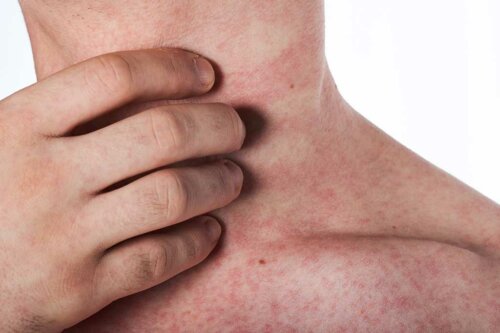 Person med epidermolysis bullosa