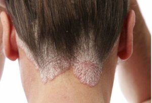 De bedste midler til behandling af ringorm i hovedbunden