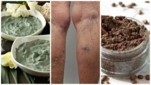 Kan du behandle åreknuder med hjemmelavede midler?