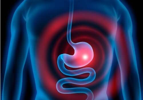 Illustration af gastritis