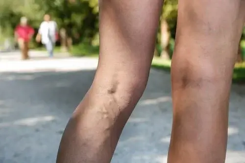 Åreknuder på ben